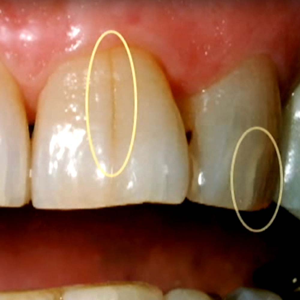 Hairline cracks in front teeth images